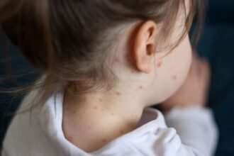 skynews-measles-stock_6367226