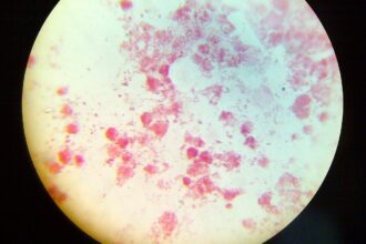 Neisseria-Gonorrhea
