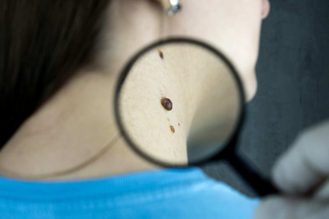The Scale of Skin Cancer in the UK