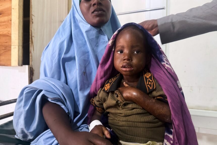 Somalia_Malnutrition_3_938